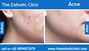 acne-treatment-before-after-photos-mumbai-india-1 (6)