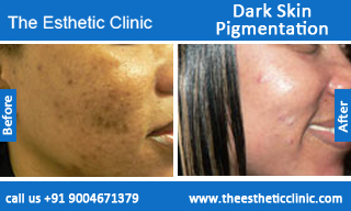 best hyperpigmentation treatment