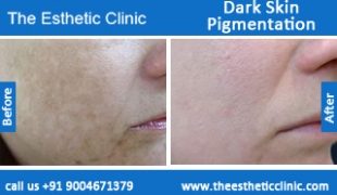 Dark-Skin-Pigmentation-treatment-before-after-photos-mumbai-india-1 (2)
