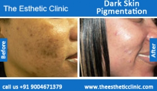 Dark-Skin-Pigmentation-treatment-before-after-photos-mumbai-india-1 (4)