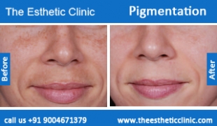 Pigmentation-treatment-before-after-photos-mumbai-india-1 (3)