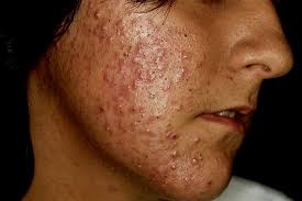 Acne (Pimple) Treatment in Mumbai, India