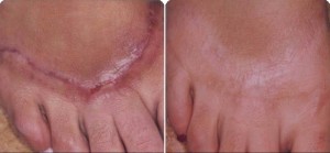 Best scar removal treatment Mumbai