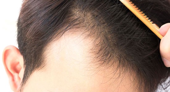 Restore lustre & volume to thinning hair with mesotherapy treatment for hair  loss - Dr Rinky Kapoor