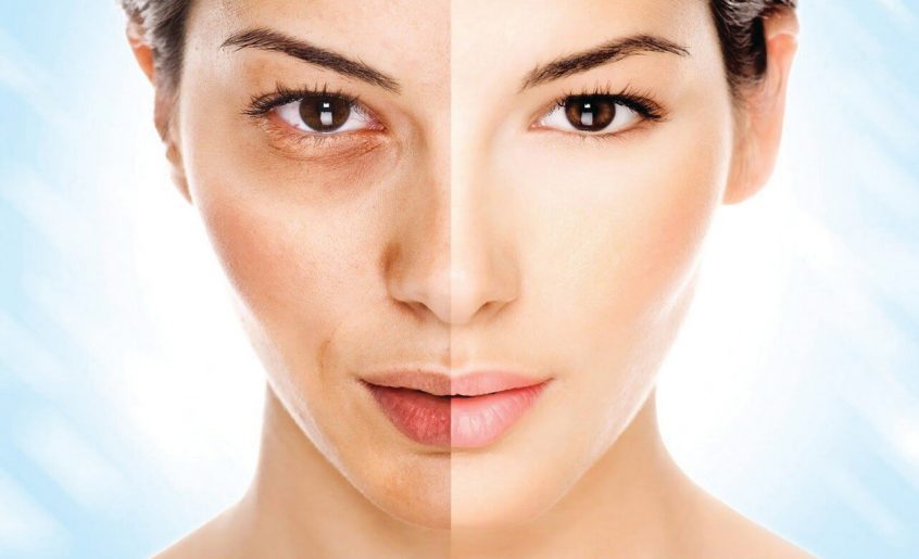 Melasma on the Face - Deciding On which Treatment is the Best One for You
