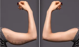 After Arm Lift Surgery