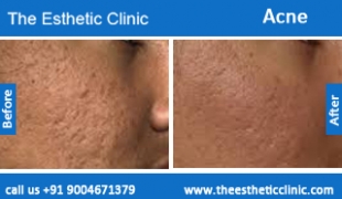 acne-treatment-before-after-photos-mumbai-india-1 (2)