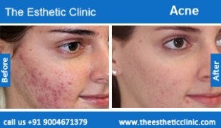 acne-treatment-before-after-photos-mumbai-india-1 (5)