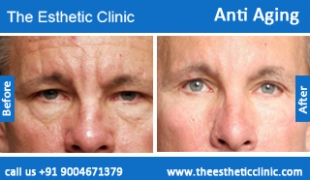 Anti-Aging-treatment-before-after-photos-mumbai-india-1 (1)