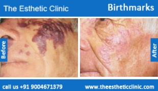 Birthmarks-removal-treatment-before-after-photos-mumbai-india-1 (1)