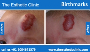 Birthmarks-removal-treatment-before-after-photos-mumbai-india-1 (2)