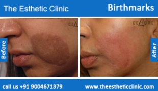 Birthmarks-removal-treatment-before-after-photos-mumbai-india-1 (3)