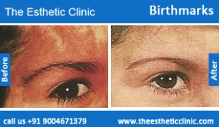 Birthmarks-removal-treatment-before-after-photos-mumbai-india-1 (4)