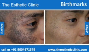 Birthmarks-removal-treatment-before-after-photos-mumbai-india-1 (5)