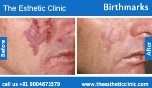 Birthmarks-removal-treatment-before-after-photos-mumbai-india-1 (6)