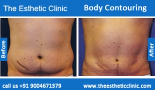 Body-Contouring-treatment-before-after-photos-mumbai-india-1 (2)