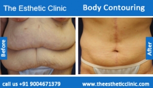 Body-Contouring-treatment-before-after-photos-mumbai-india-1 (4)