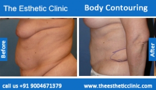 Body-Contouring-treatment-before-after-photos-mumbai-india-1 (5)
