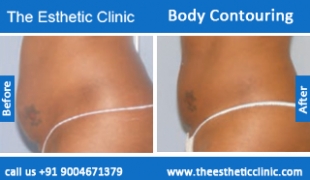 Body-Contouring-treatment-before-after-photos-mumbai-india-1 (6)