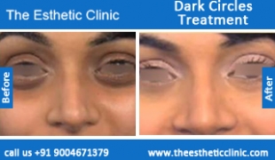 Dark-Circles-treatment-before-after-photos-mumbai-india-1 (4)
