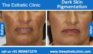 Dark-Skin-Pigmentation-treatment-before-after-photos-mumbai-india-1 (5)