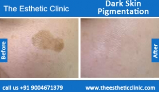Dark-Skin-Pigmentation-treatment-before-after-photos-mumbai-india-1 (6)