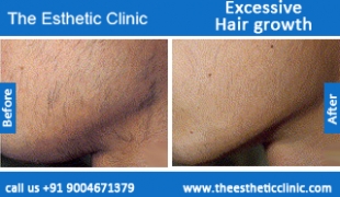 Excessive-Hair-growth-treatment-before-after-photos-mumbai-india-1 (1)