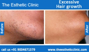 Excessive-Hair-growth-treatment-before-after-photos-mumbai-india-1 (2)