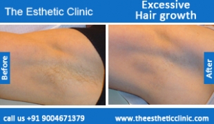 Excessive-Hair-growth-treatment-before-after-photos-mumbai-india-1 (3)
