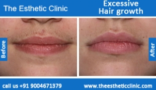 Excessive-Hair-growth-treatment-before-after-photos-mumbai-india-1 (4)