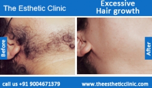 Excessive-Hair-growth-treatment-before-after-photos-mumbai-india-1 (5)