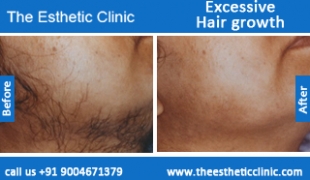 Excessive-Hair-growth-treatment-before-after-photos-mumbai-india-1 (6)