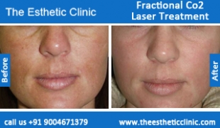 Fractional-Co2-Laser-treatment-before-after-photos-mumbai-india-1 (3)