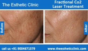 Fractional-Co2-Laser-treatment-before-after-photos-mumbai-india-1 (4)