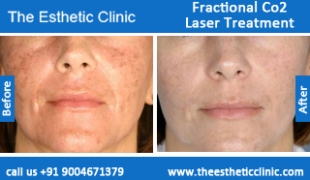 Fractional-Co2-Laser-treatment-before-after-photos-mumbai-india-1 (6)