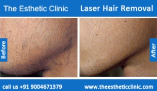Laser-Hair-Removal-treatment-before-after-photos-mumbai-india-1 (1)