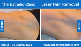 Laser-Hair-Removal-treatment-before-after-photos-mumbai-india-1 (3)