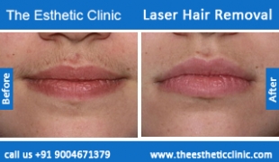 Laser-Hair-Removal-treatment-before-after-photos-mumbai-india-1 (4)