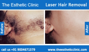 Laser-Hair-Removal-treatment-before-after-photos-mumbai-india-1 (5)