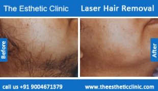 Laser-Hair-Removal-treatment-before-after-photos-mumbai-india-1 (6)