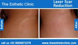 Laser-Scar-Reduction-treatment-before-after-photos-mumbai-india-1 (1)