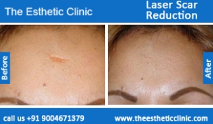 Laser-Scar-Reduction-treatment-before-after-photos-mumbai-india-1 (2)