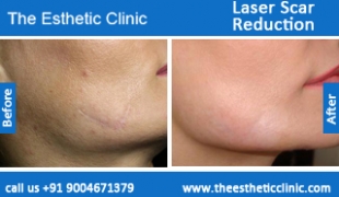 Laser-Scar-Reduction-treatment-before-after-photos-mumbai-india-1 (3)
