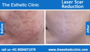 Laser-Scar-Reduction-treatment-before-after-photos-mumbai-india-1 (4)
