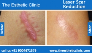 Laser-Scar-Reduction-treatment-before-after-photos-mumbai-india-1 (5)