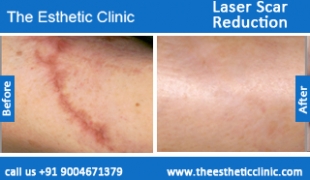Laser-Scar-Reduction-treatment-before-after-photos-mumbai-india-1 (6)