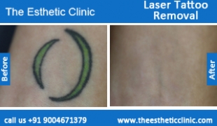 Laser-Tattoo-Removal-treatment-before-after-photos-mumbai-india-1 (1)