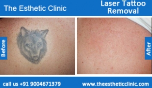 Laser-Tattoo-Removal-treatment-before-after-photos-mumbai-india-1 (2)