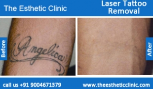 Laser-Tattoo-Removal-treatment-before-after-photos-mumbai-india-1 (3)