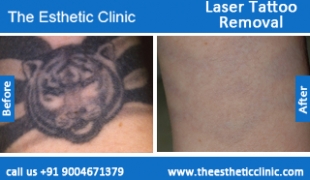 Laser-Tattoo-Removal-treatment-before-after-photos-mumbai-india-1 (4)